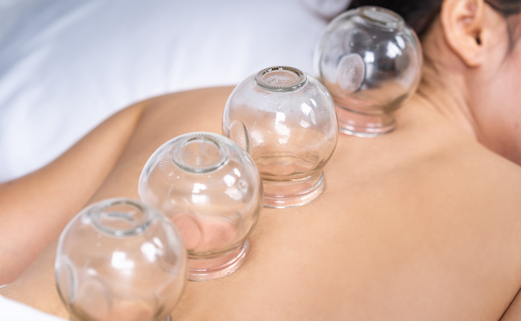 The Sleep and Health Benefits of Cupping